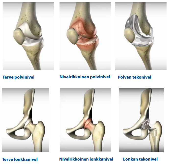 Остеоартроз это. Стадии доа тазобедренного сустава. Остеоартроз коленного суста. Артроз коленного сустава эндопротезирование. Артроз коленного сустава эндопротез.